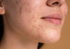 SP busca voluntários para projeto que testa eficácia de tratamento para acne